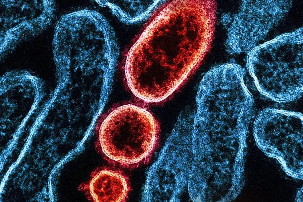 image of nipah virus symptoms: ano ang nipah virus at bakit ito pinag-iingatan